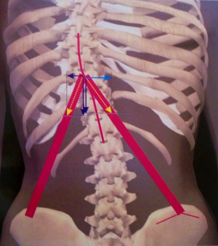 scoliosi sinistro convessa